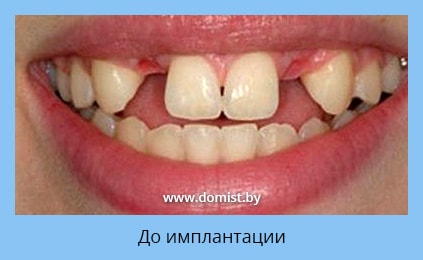 Состояние зубов до имплантации