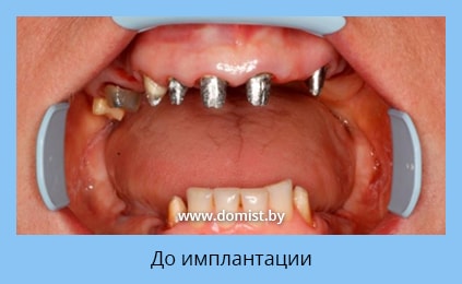 Состояние зубов до имплантации