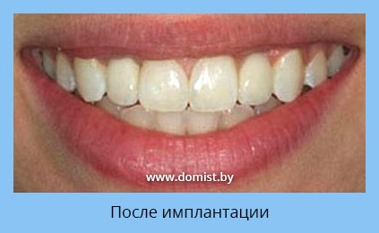 Состояние зубов после имплантации