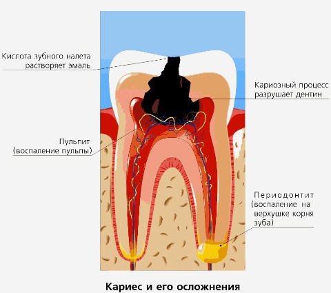 Кариес - терапевтическая стоматология Домист