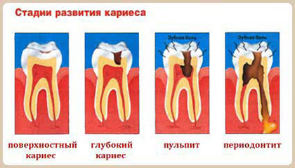 Стадии развития кариеса - Терапевтическая стоматология